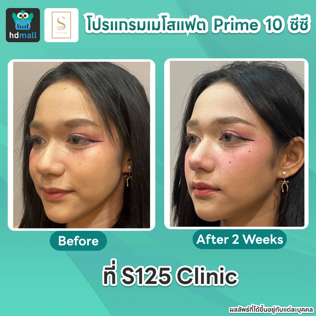 โปรแกรมเมโสแฟตหน้า Prime 10 ซีซี