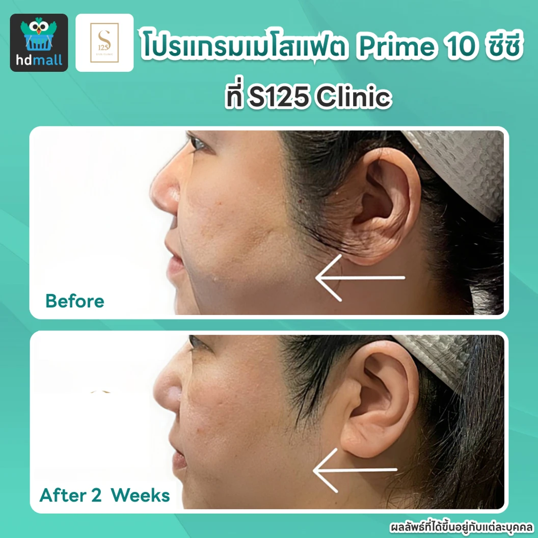 โปรแกรมเมโสแฟตหน้า Prime 10 ซีซี