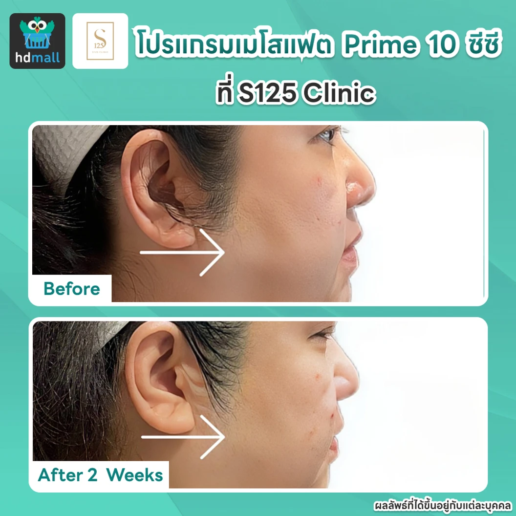 โปรแกรมเมโสแฟตหน้า Prime 10 ซีซี