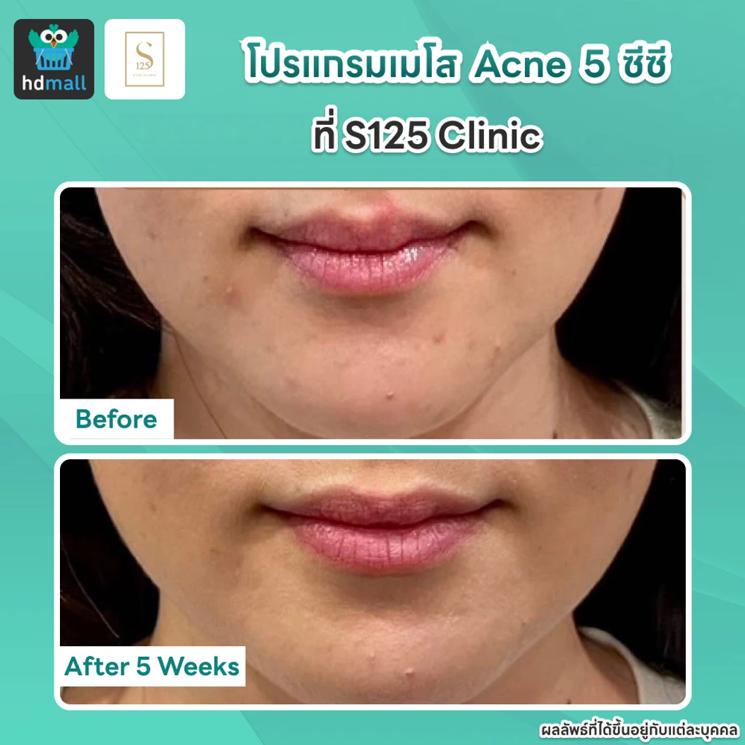 คอร์สโปรแกรมเมโสหน้า Acne 5 ซีซี 5 ครั้ง