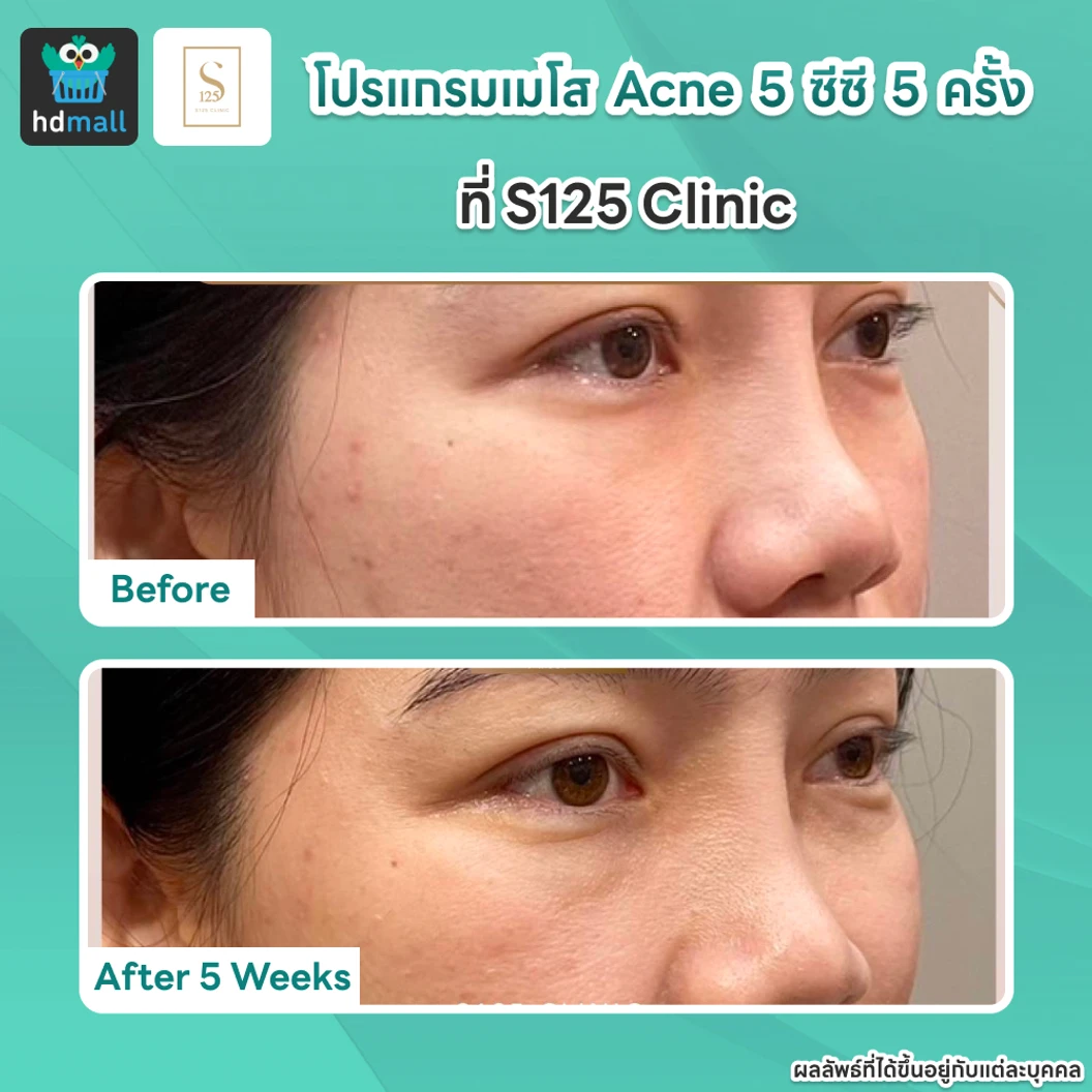 คอร์สโปรแกรมเมโสหน้า Acne 5 ซีซี 5 ครั้ง