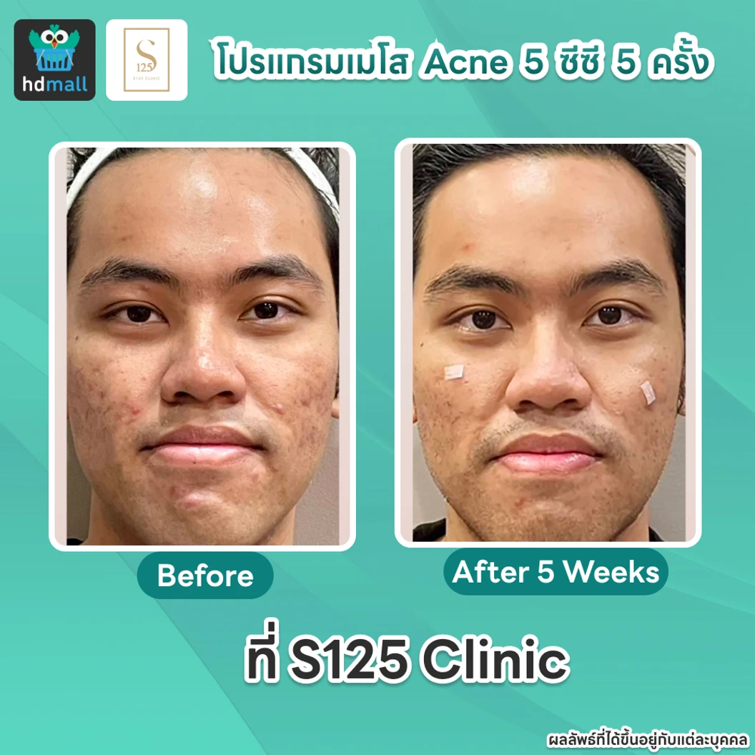 คอร์สโปรแกรมเมโสหน้า Acne 5 ซีซี 5 ครั้ง
