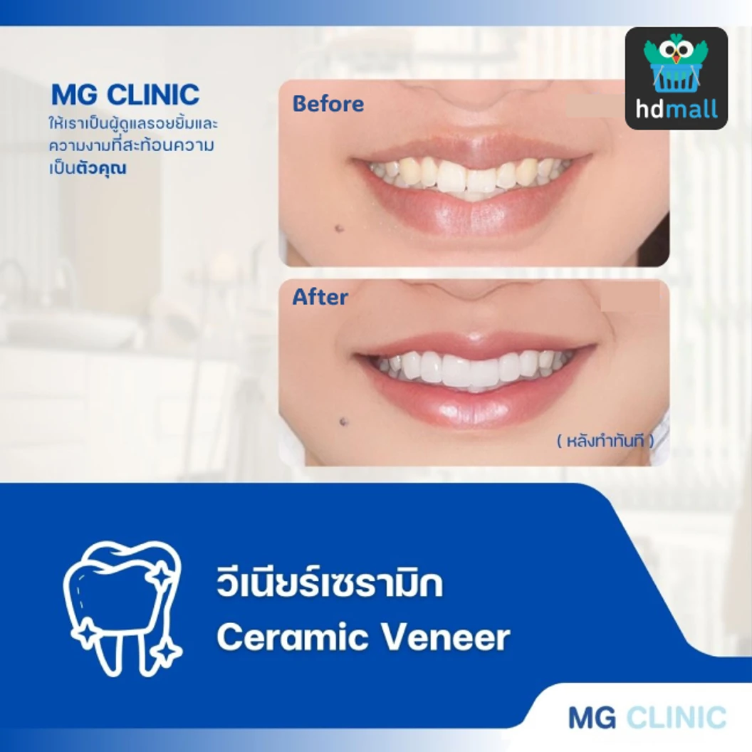 ทำวีเนียร์เซรามิกหรือพอร์ซเลน E-Max 1 ซี่