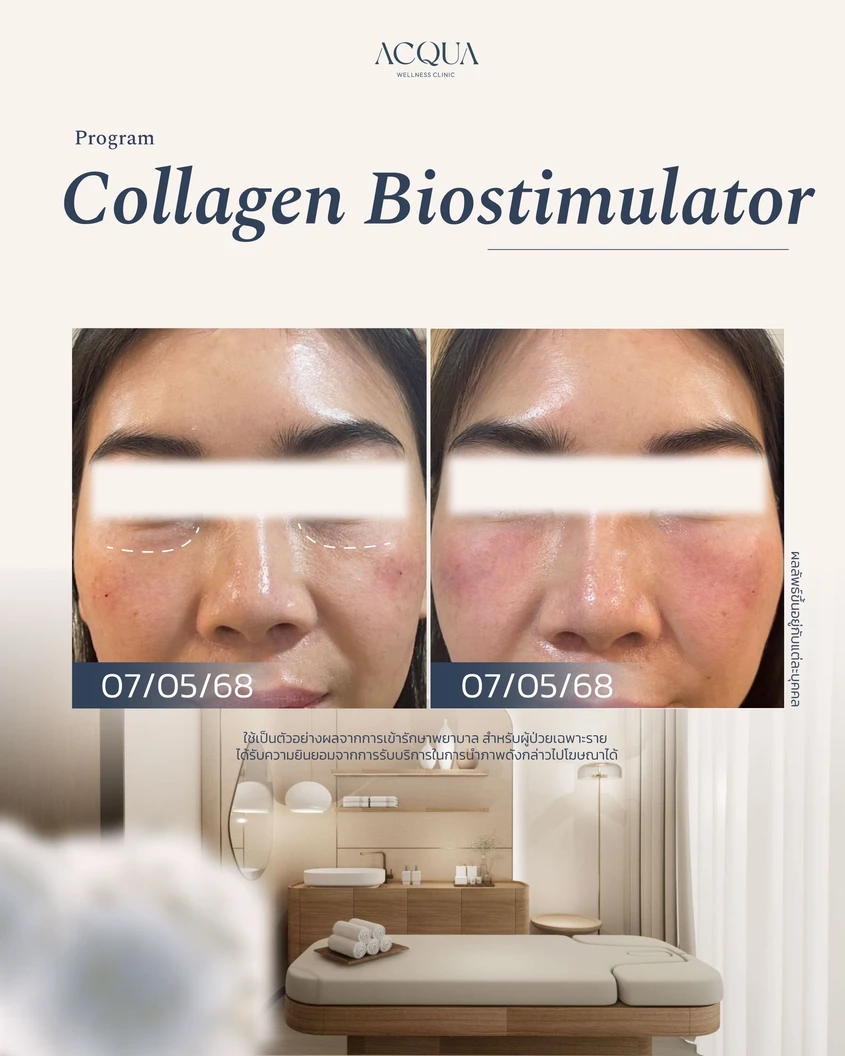 โปรแกรม Collagen Biostimulators 10 ซีซี (หน้า)