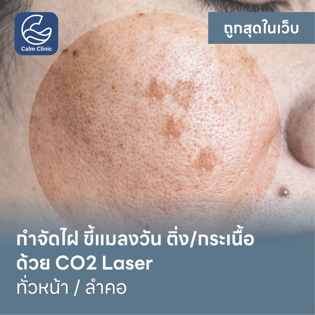 กำจัดไฝ ขี้แมลงวัน ติ่งเนื้อ กระเนื้อ ด้วย CO2 Laser ขนาดเส้นผ่านศูนย์กลางไม่เกิน 2 มม. ไม่จำกัดจุดทั่วใบหน้าหรือลำคอ 1 ครั้ง