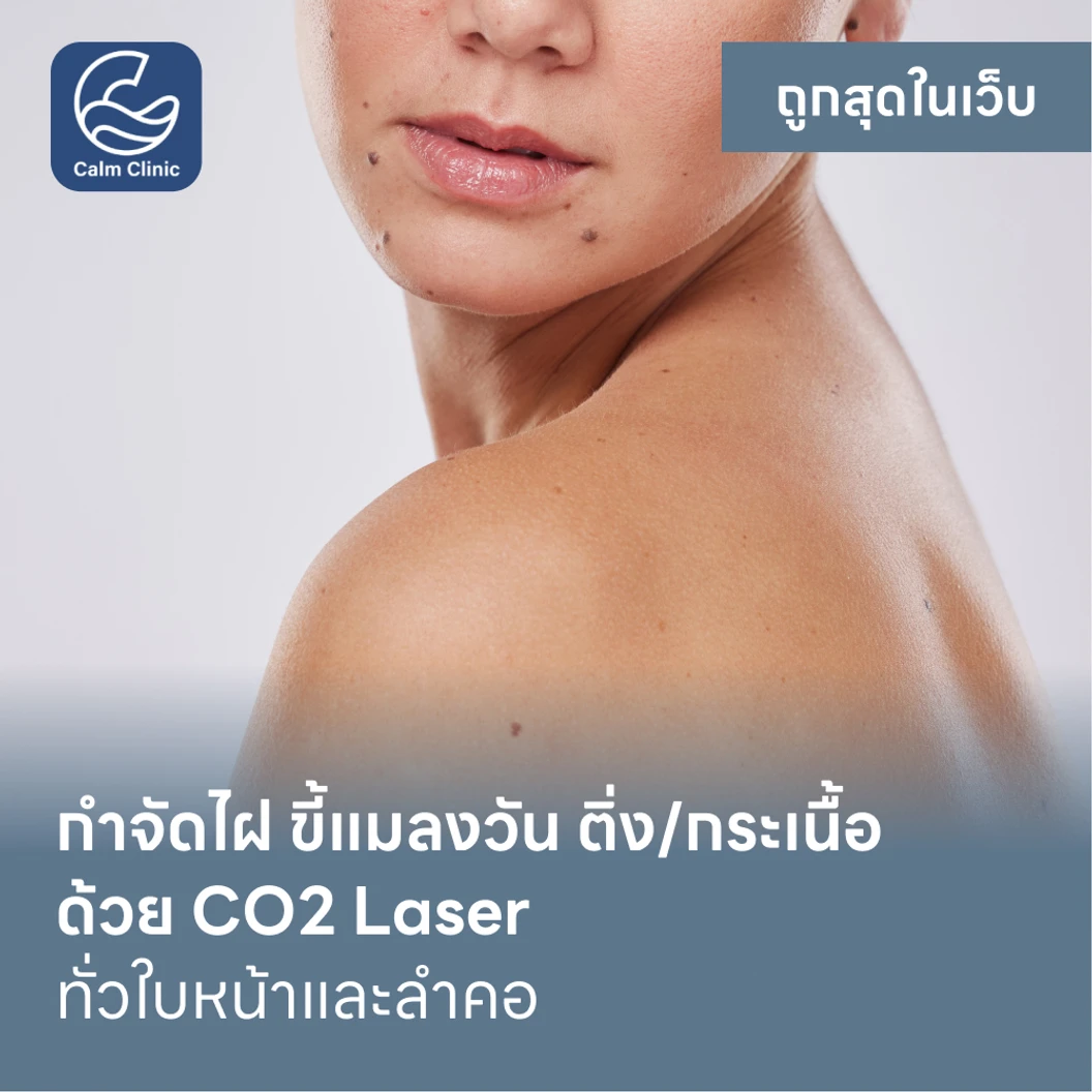 กำจัดไฝ ขี้แมลงวัน ติ่งเนื้อ กระเนื้อ ด้วย CO2 Laser ขนาดเส้นผ่านศูนย์กลางไม่เกิน 2 มม. ไม่จำกัดจุดทั่วใบหน้าและลำคอ 1 ครั้ง