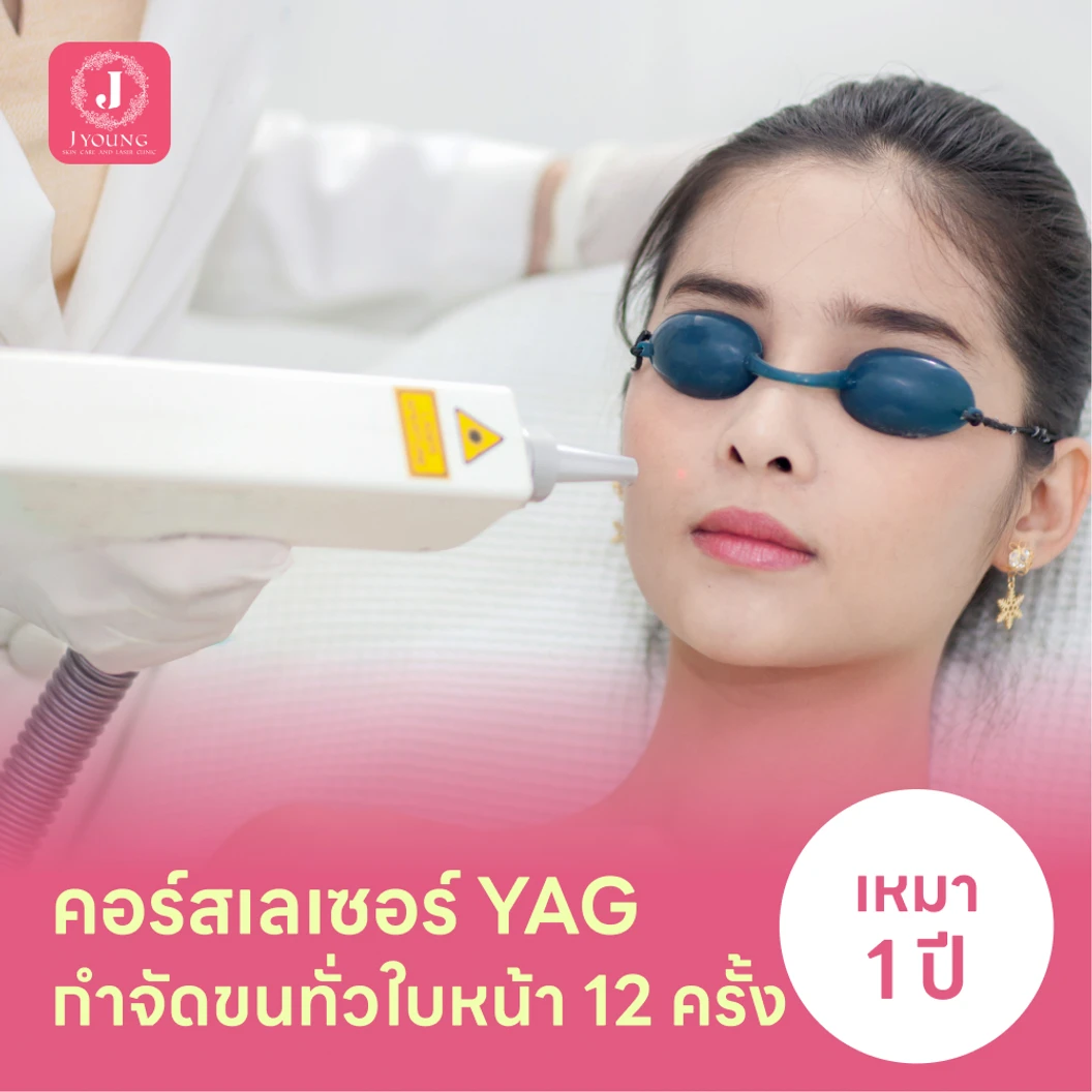 คอร์สเลเซอร์กำจัดขนทั่วหน้า 12 ครั้ง ด้วย YAG Laser