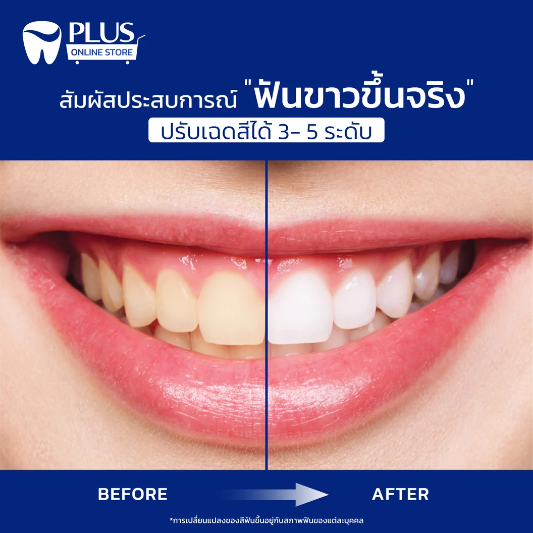 ชุดฟอกสีฟันที่บ้าน Opalescence Home 1 หลอด ฟรี! ถาดฟอกสีฟันเฉพาะบุคคล