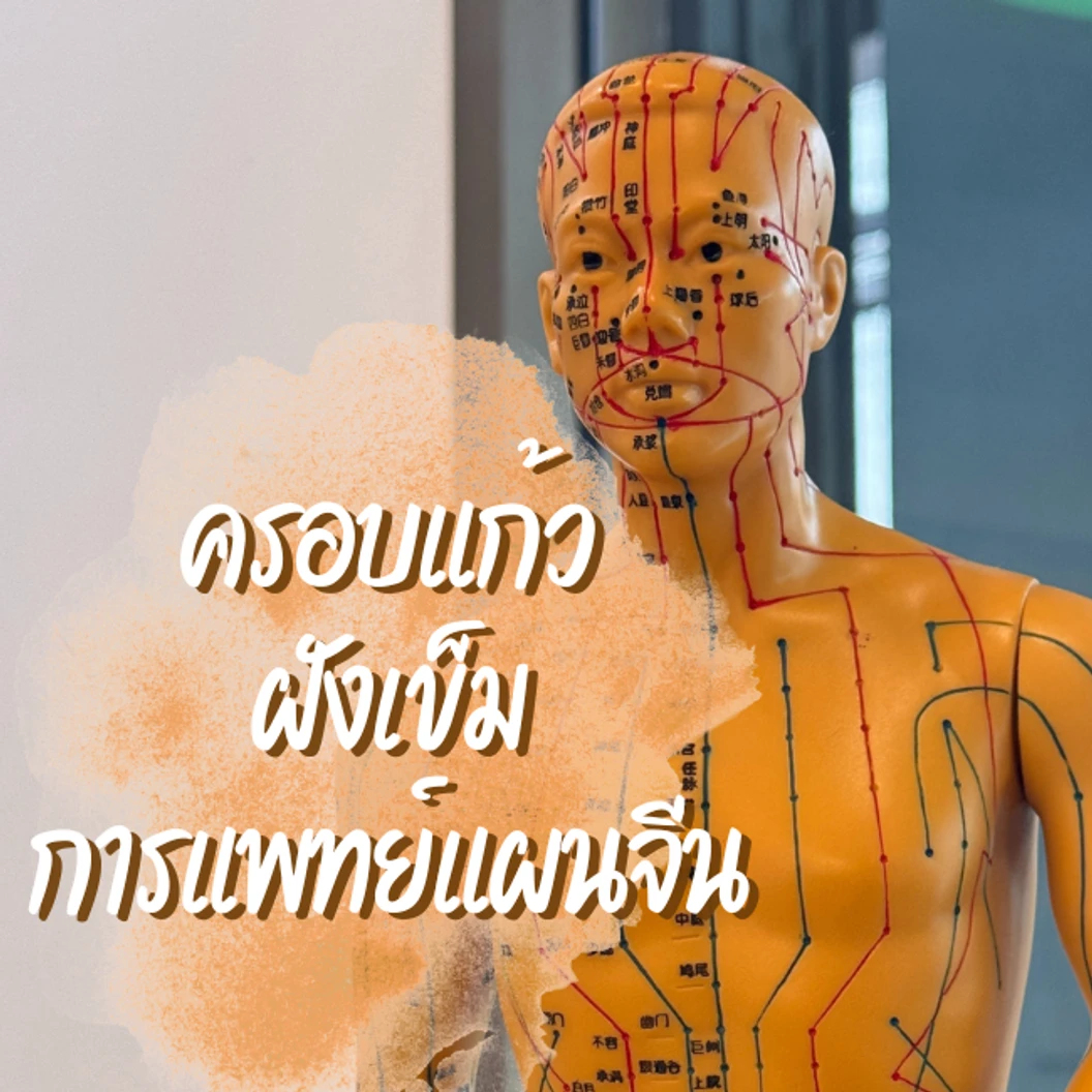 ฝังเข็ม + ครอบแก้ว คลายจุดกล้ามเนื้อตามร่างกาย
