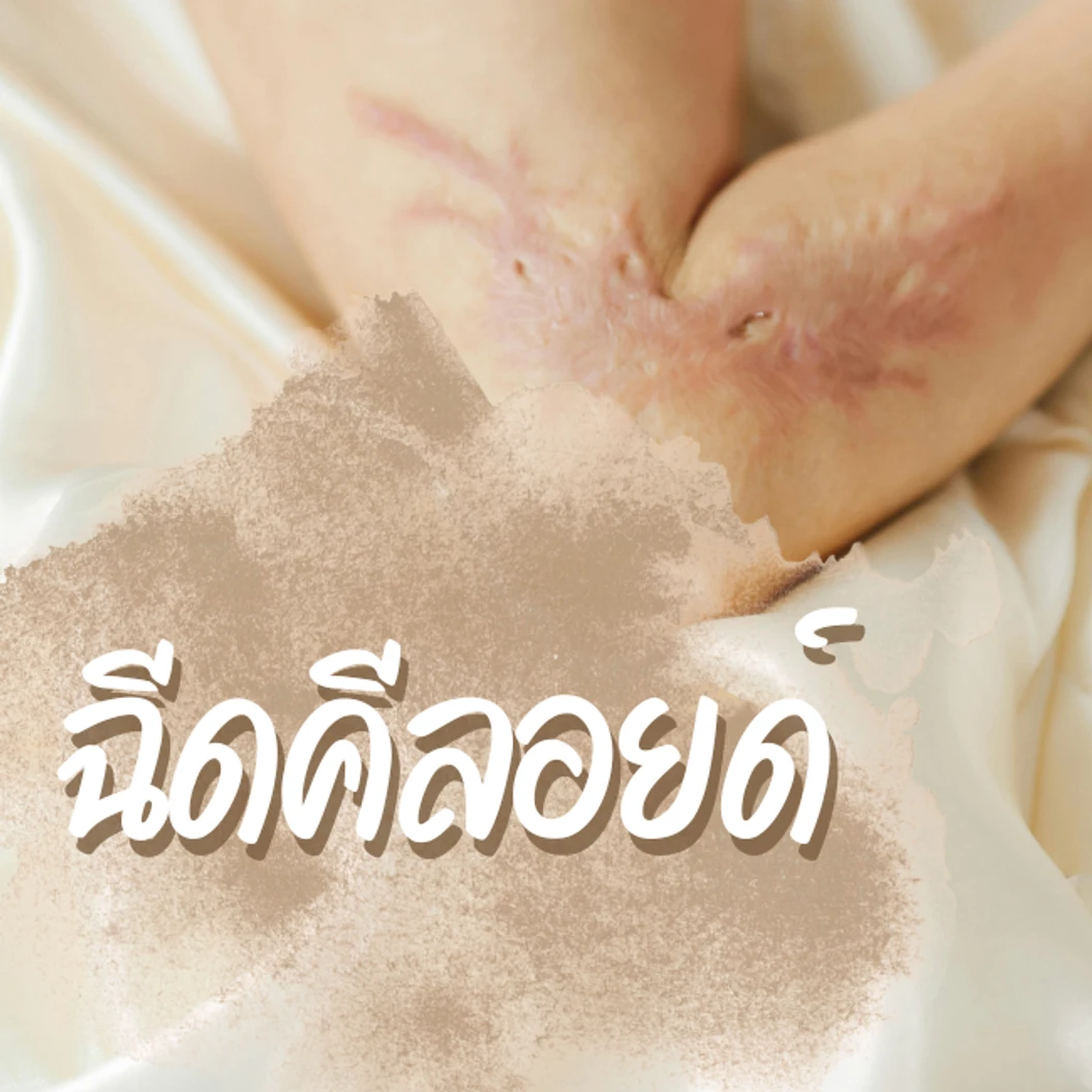 ฉีดรักษาแผลเป็นคีลอยด์ ขนาดไม่เกิน 1 ซม. ไม่จำกัดจุด
