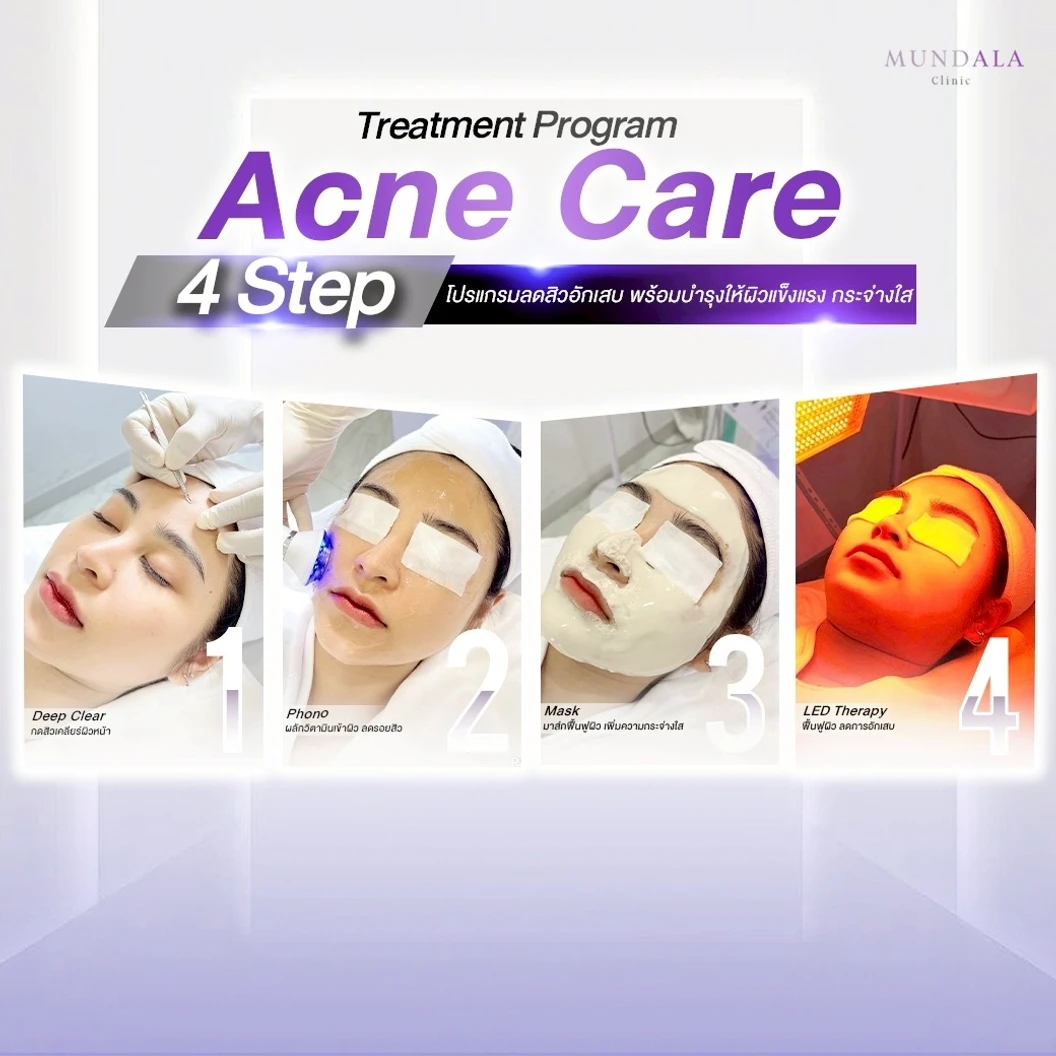 รักษาสิวหน้า (Acne Care 4 Step) 4 ขั้นตอน