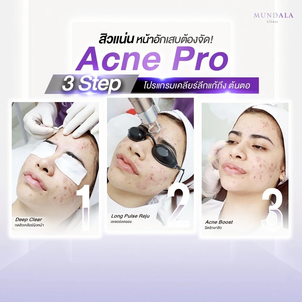 ทำทรีตเมนต์หน้า (โปรแกรม Acne Pro) 3 ขั้นตอน