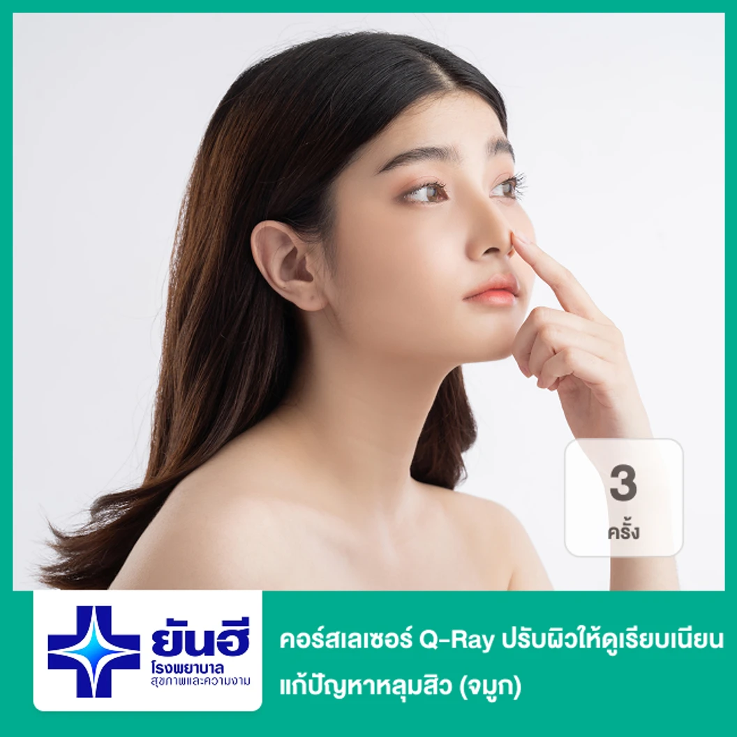 คอร์สเลเซอร์ Q-Ray ปรับผิวให้ดูเรียบเนียน แก้ปัญหาหลุมสิว 3 ครั้ง (จมูก)