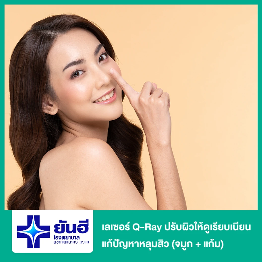 เลเซอร์ Q-Ray ปรับผิวให้ดูเรียบเนียน แก้ปัญหาหลุมสิว (จมูก + แก้ม)