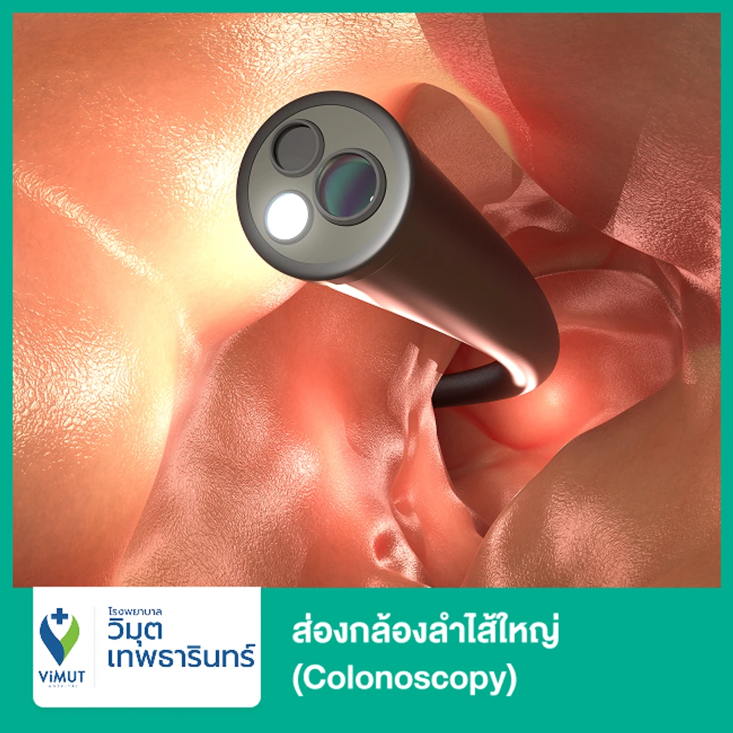 ส่องกล้องลำไส้ใหญ่ (Colonoscopy) ด้วยวิธีให้ยานอนหลับ โดยวิสัญญีแพทย์