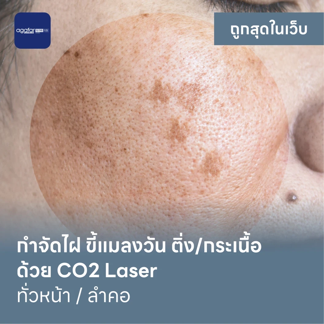 กำจัดไฝ ขี้แมลงวัน ติ่งเนื้อ กระเนื้อ ด้วย CO2 Laser ขนาดเส้นผ่านศูนย์กลางไม่เกิน 2 มม. ไม่จำกัดจุดทั่วใบหน้าหรือลำคอ 1 ครั้ง