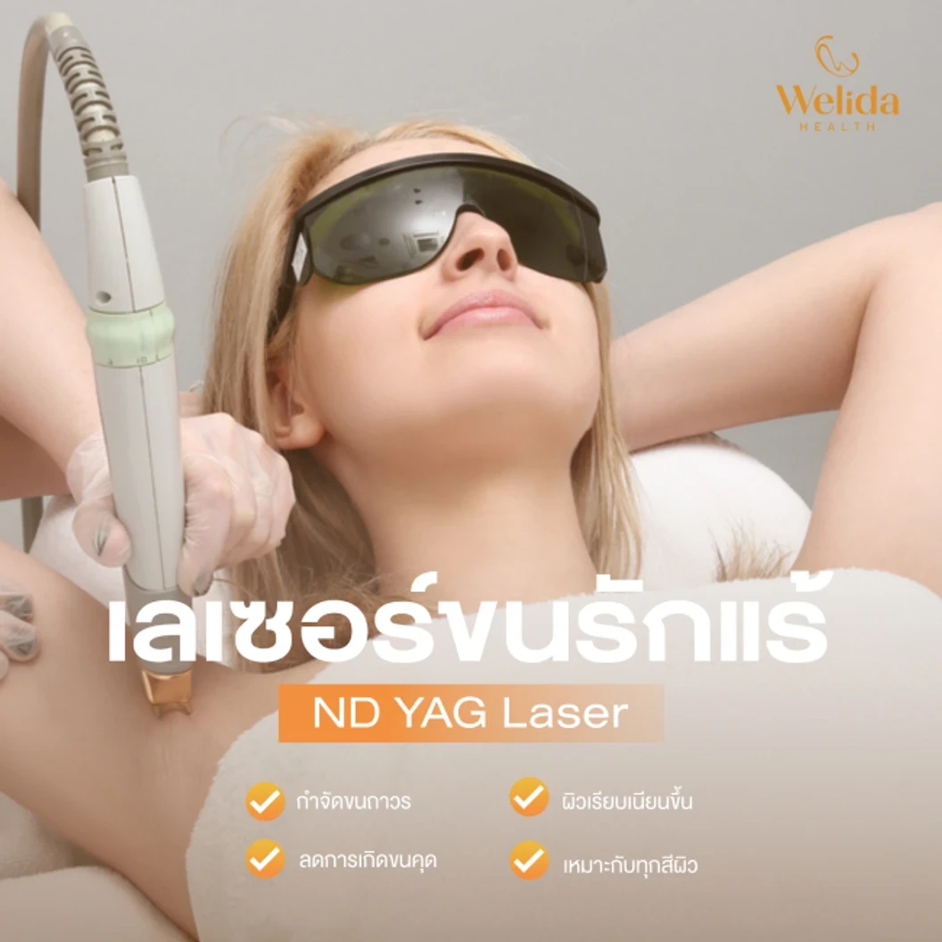 เลเซอร์ Nd:YAG กำจัดขนรักแร้ 1 ครั้ง
