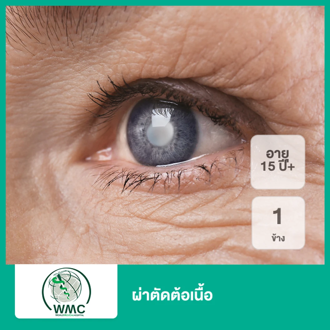 ผ่าตัดต้อเนื้อ 1 ข้าง (15 ปีขึ้นไป)