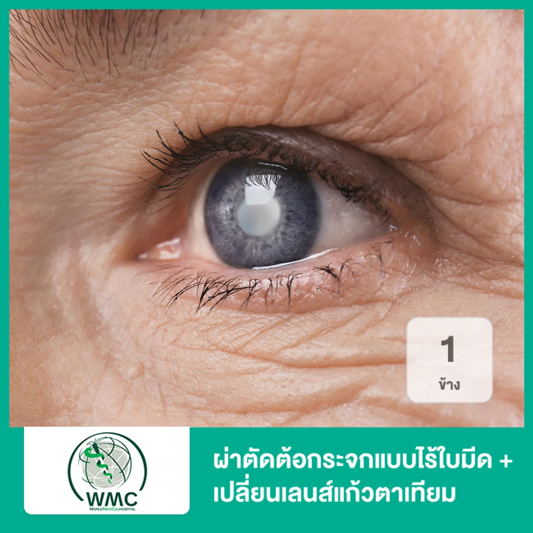 ผ่าตัดสลายต้อกระจกด้วยคลื่นอัลตราซาวด์และเปลี่ยนเลนส์แก้วตาเทียมชนิดพับได้ กรองแสง ชัด 1 ระยะ 1 ข้าง