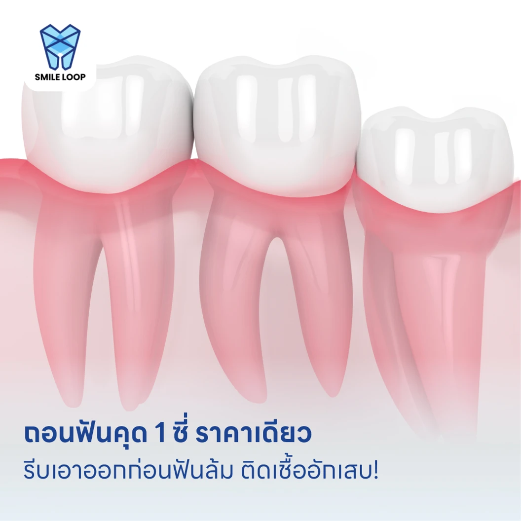 ถอนฟันคุด 1 ซี่ ราคาเดียว