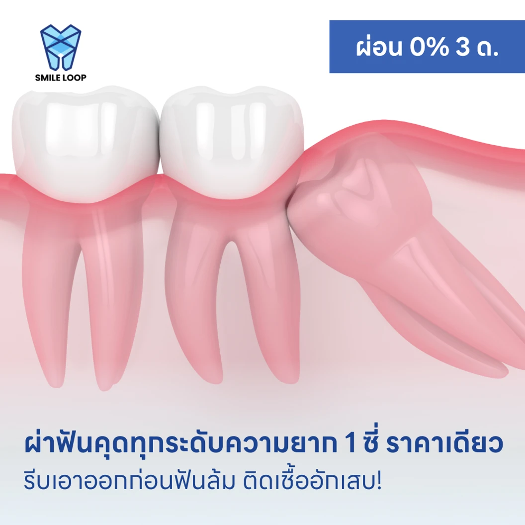 ผ่าฟันคุดทุกระดับความยาก 1 ซี่ ราคาเดียว