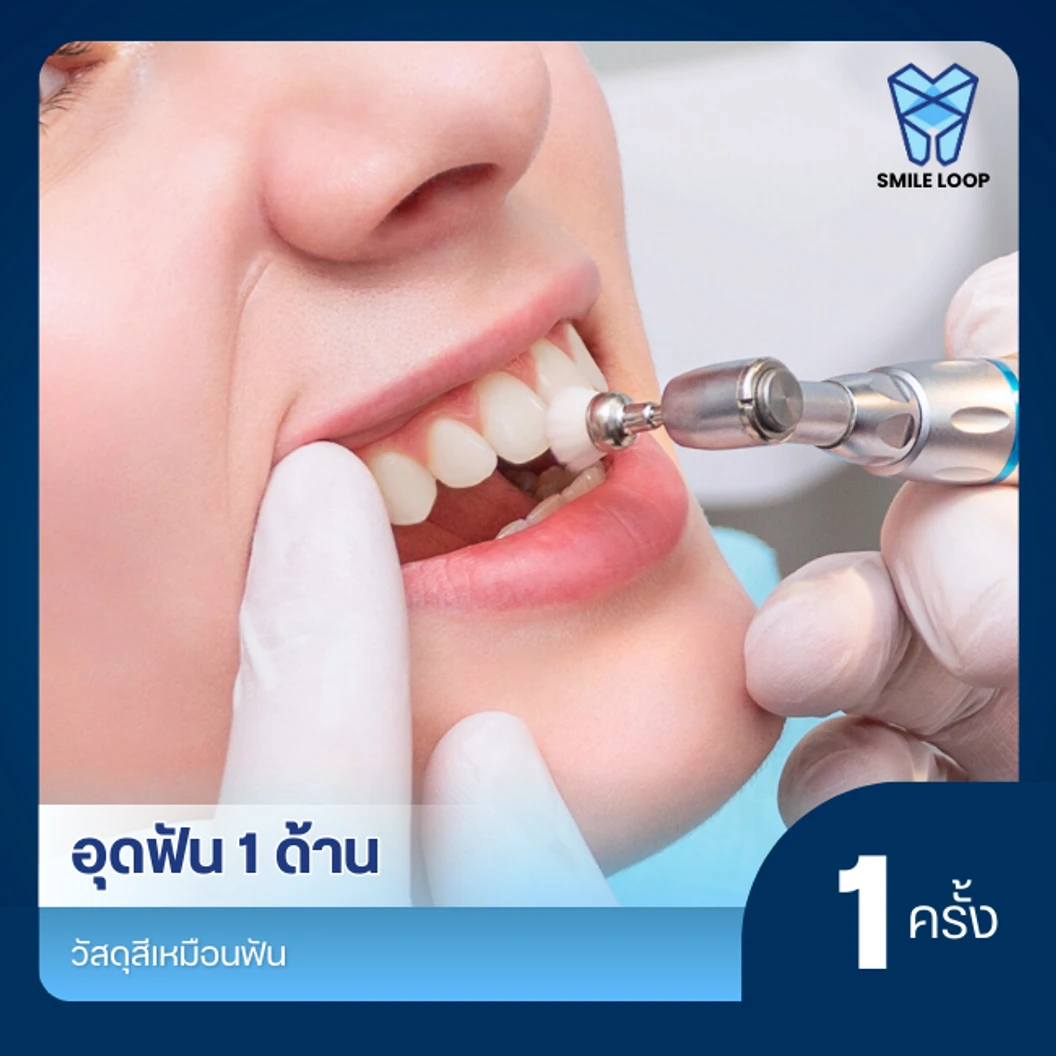 อุดฟัน 1 ด้าน ด้วยวัสดุสีเหมือนฟัน