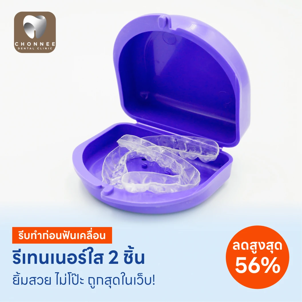 ทำรีเทนเนอร์แบบใส 2 ชิ้น
