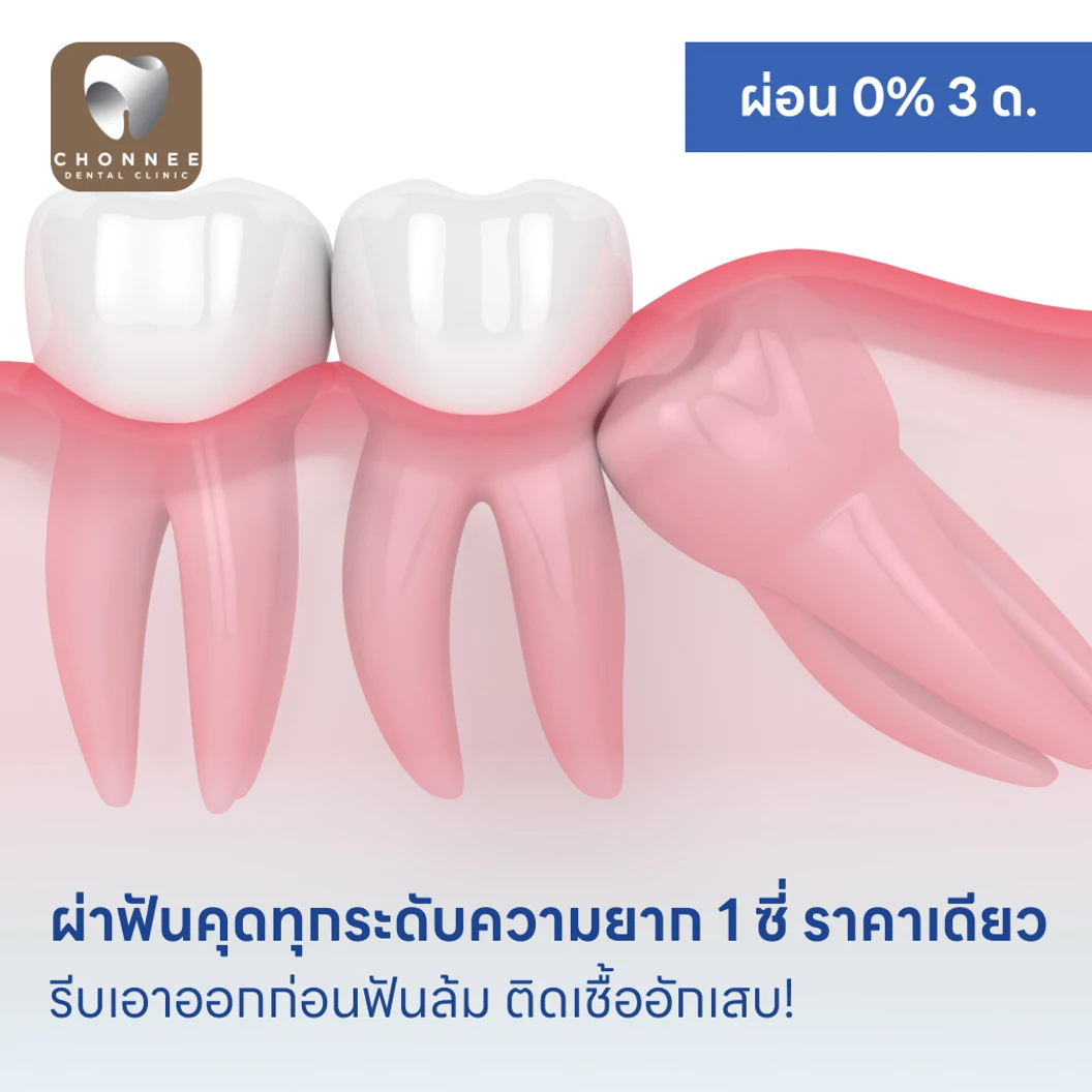 ผ่าฟันคุดทุกระดับความยาก 1 ซี่ ราคาเดียว
