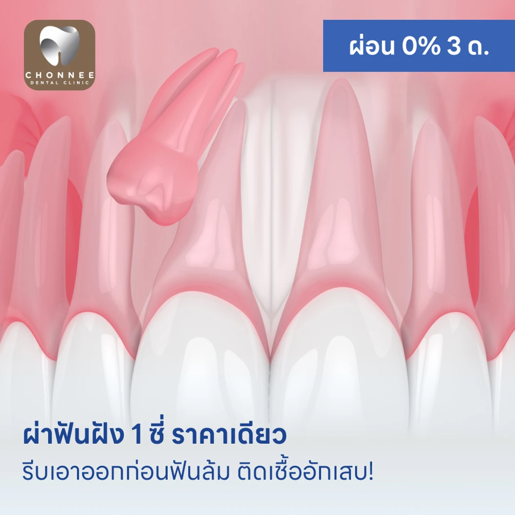 ผ่าฟันฝัง 1 ซี่ ราคาเดียว