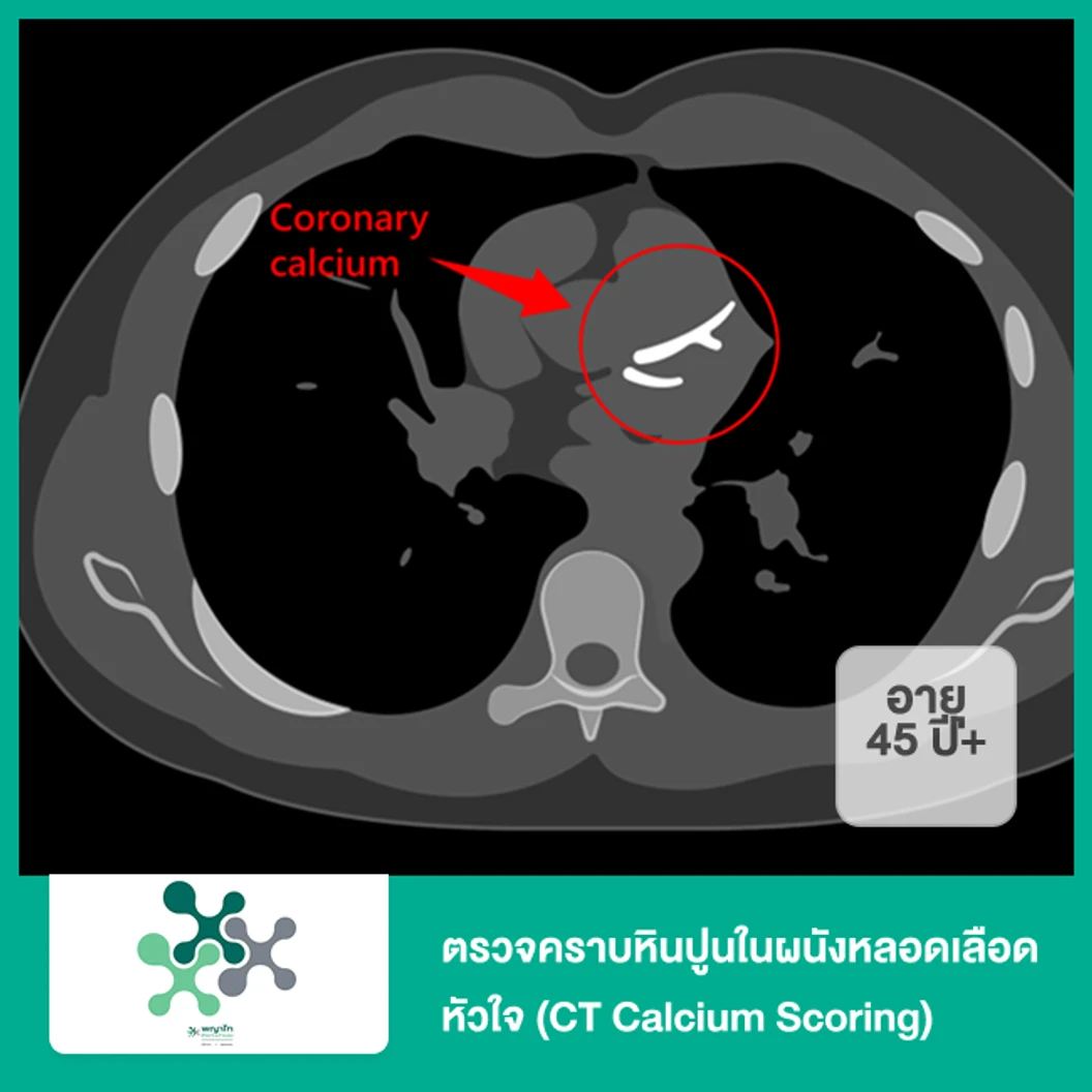 ตรวจคราบหินปูนในผนังหลอดเลือดหัวใจ (CT Calcium Scoring) (45 ปีขึ้นไป)