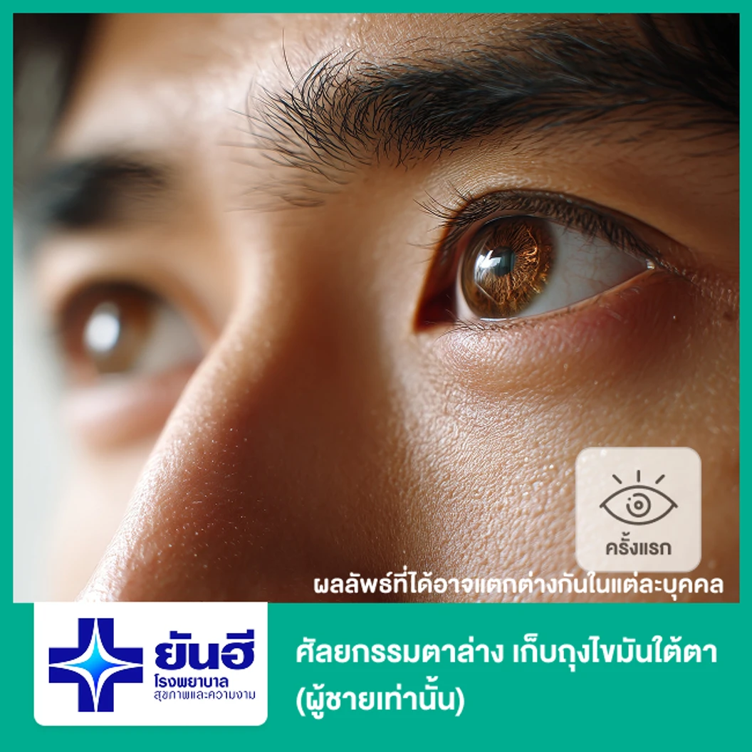 ศัลยกรรมตาล่าง เก็บถุงไขมันใต้ตา (ผู้ชายเคสทำครั้งแรกเท่านั้น)