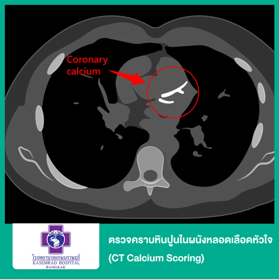 ตรวจคราบหินปูนในผนังหลอดเลือดหัวใจ (CT Calcium Scoring) (สำหรับทุกช่วงวัย)