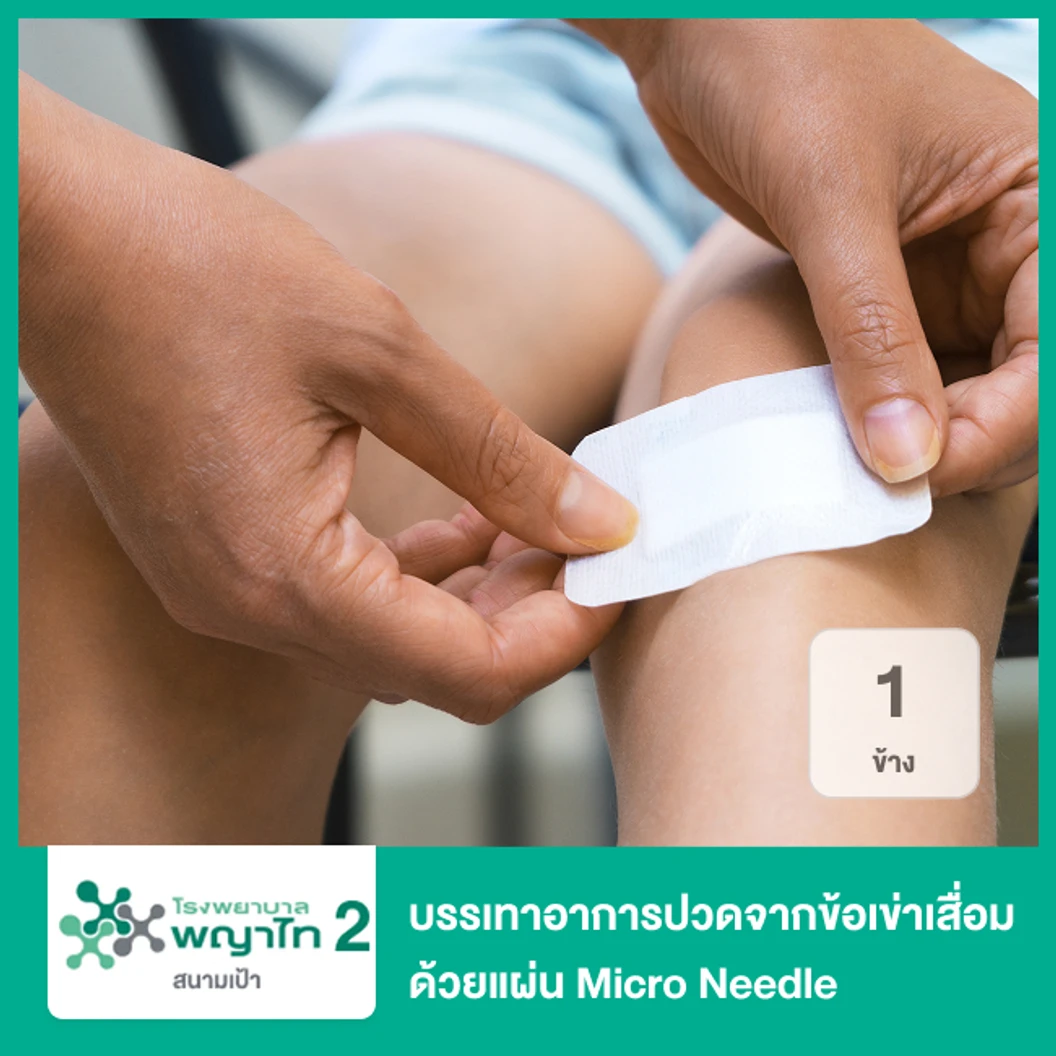บรรเทาอาการปวดจากข้อเข่าเสื่อม ด้วยแผ่น Micro Needle 1 ข้าง