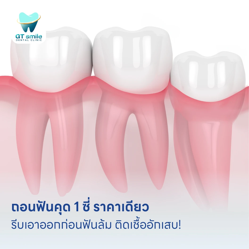 ถอนฟันคุด 1 ซี่ ราคาเดียว