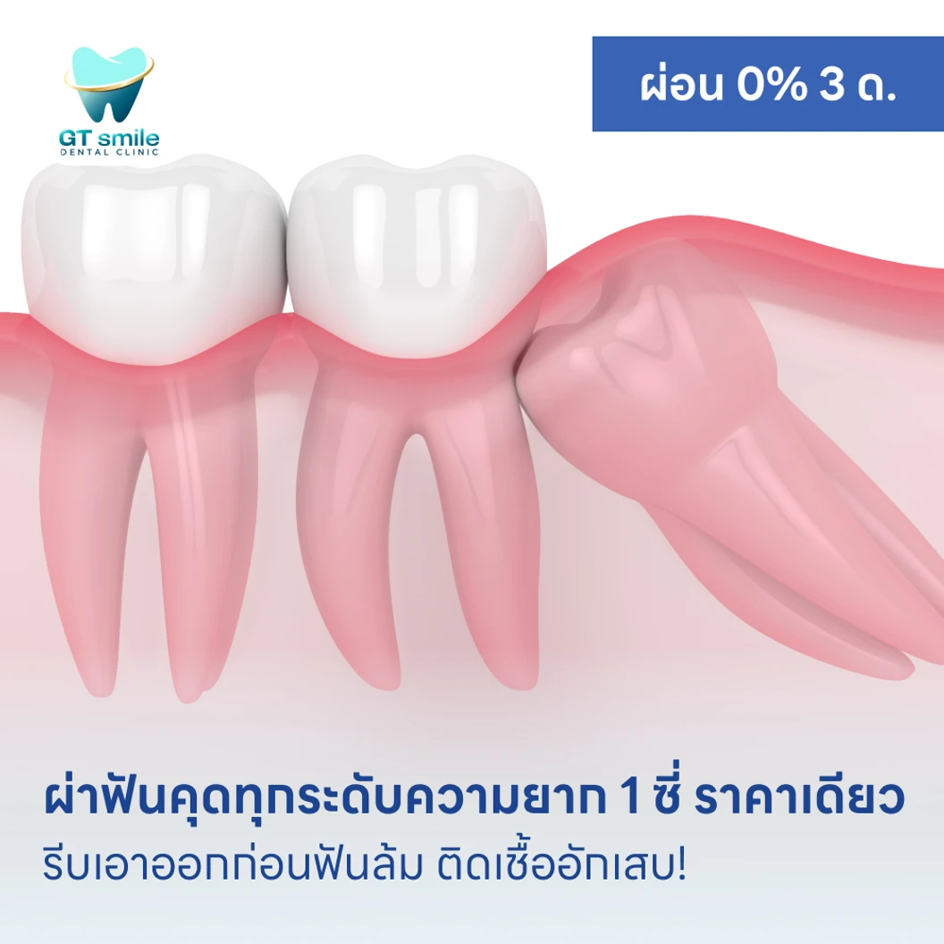 ผ่าฟันคุดทุกระดับความยาก 1 ซี่ ราคาเดียว