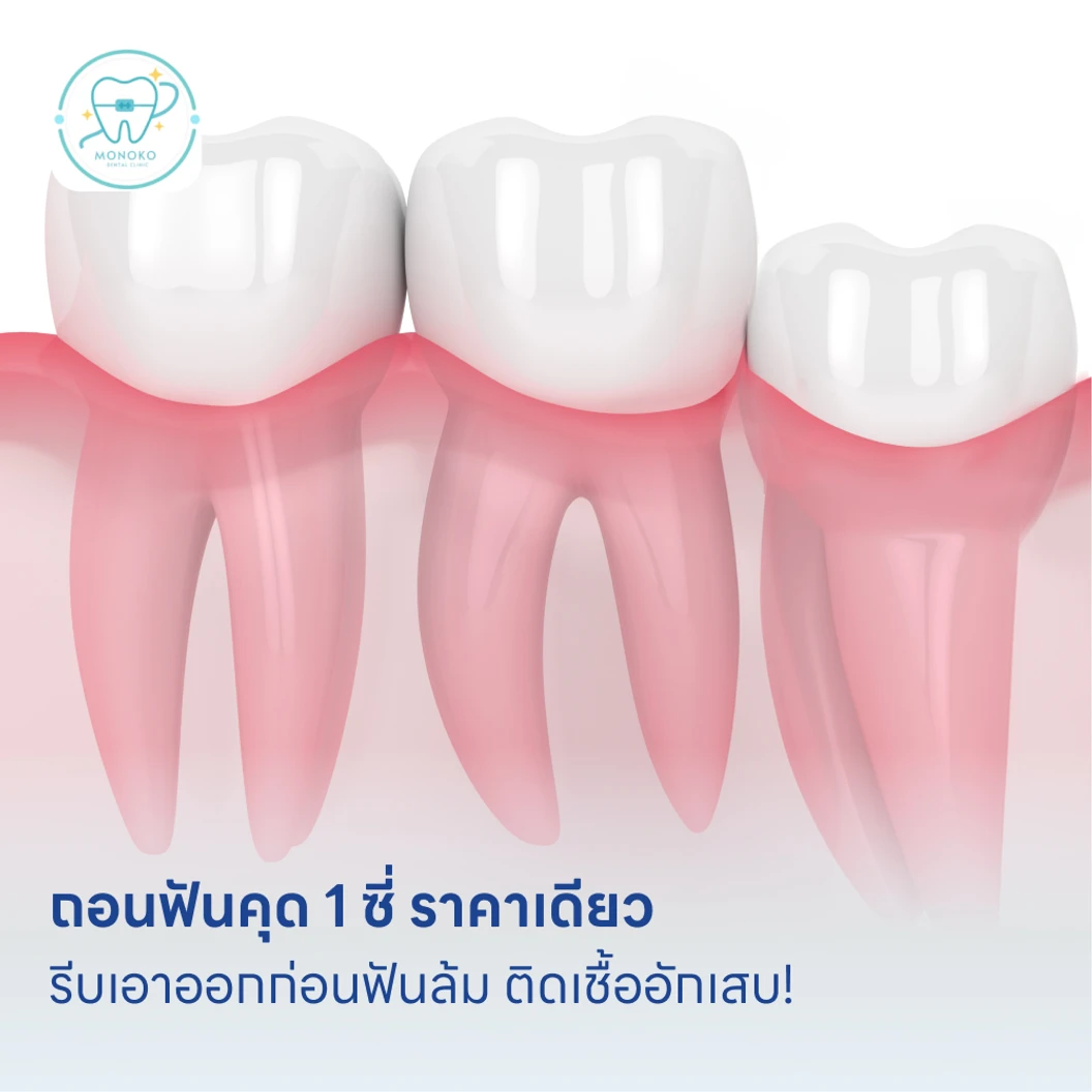 ถอนฟันคุด 1 ซี่ ราคาเดียว