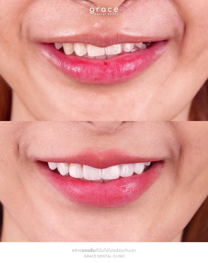 ทำวีเนียร์เซรามิก E-Max Press 6 ซี่