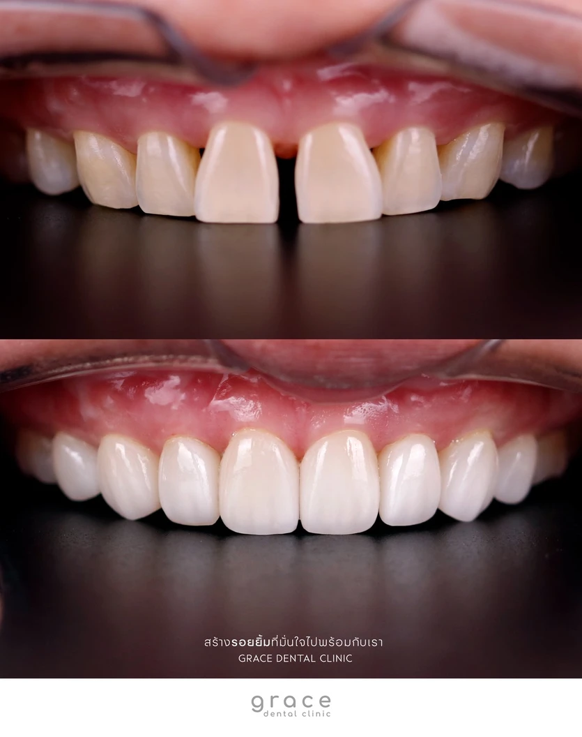 ทำวีเนียร์เซรามิก E-Max Press 6 ซี่