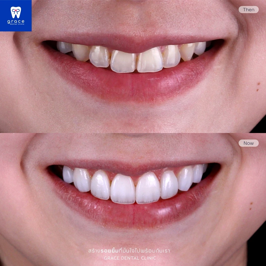 ทำวีเนียร์เซรามิก E-Max Press 8 ซี่