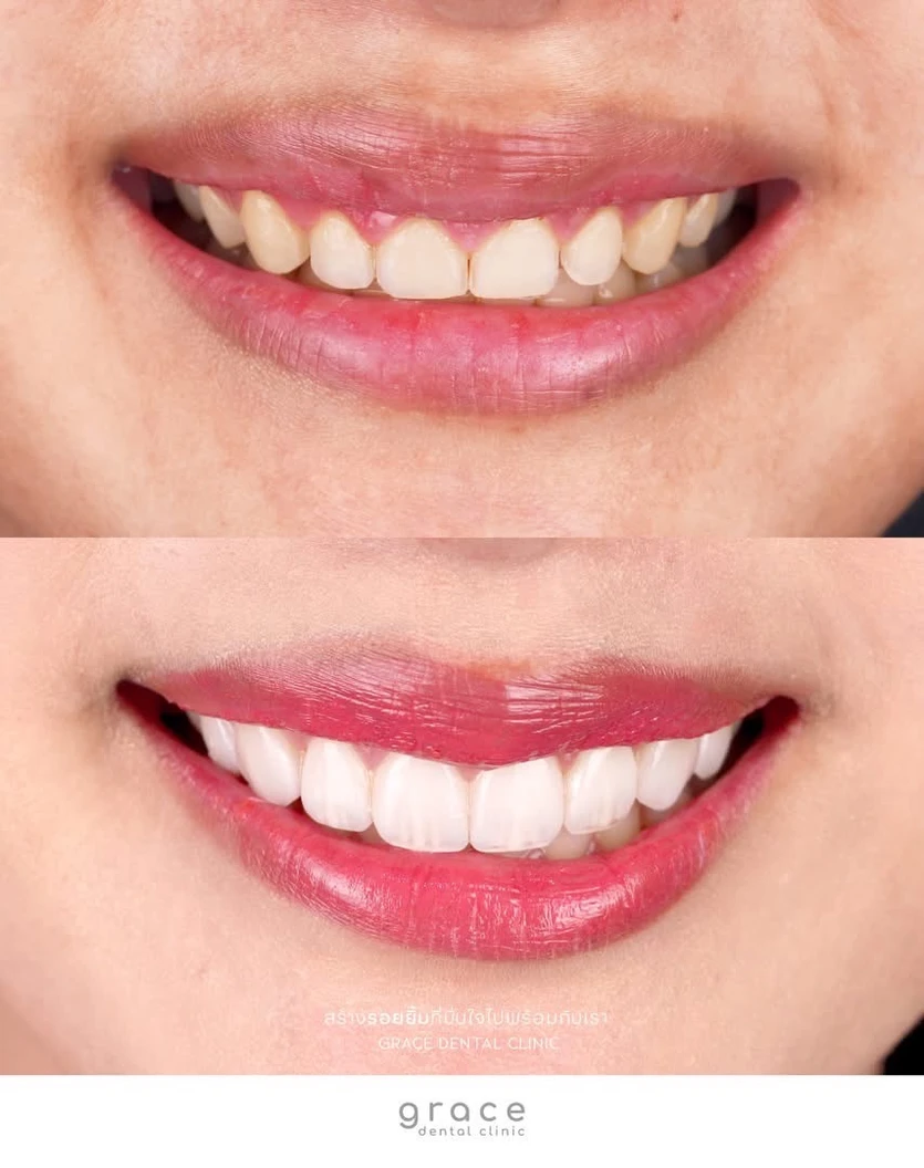 ทำวีเนียร์เซรามิก E-Max Press 8 ซี่