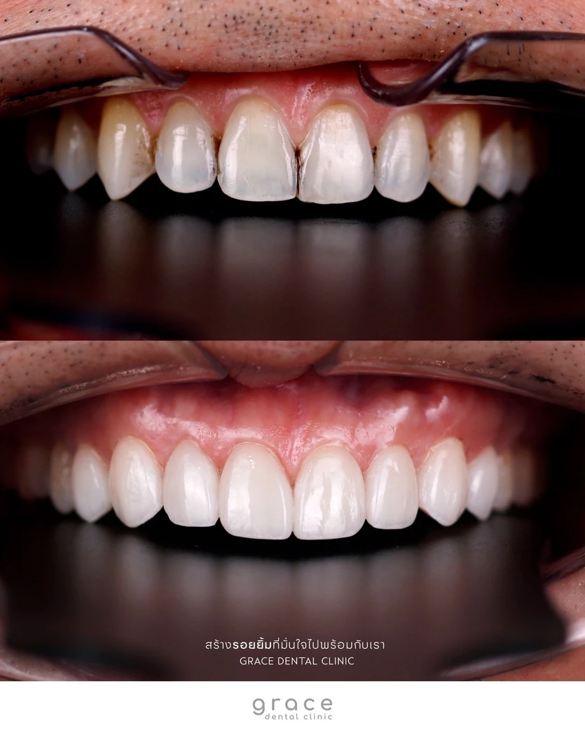 ทำวีเนียร์เซรามิก E-Max Press 16 ซี่