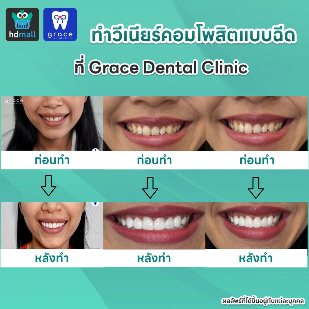 ทำวีเนียร์คอมโพสิตแบบฉีด 8 ซี่