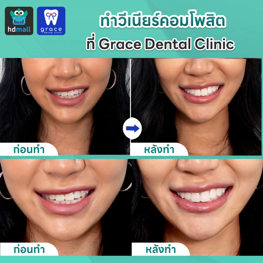 ทำวีเนียร์คอมโพสิต 16 ซี่