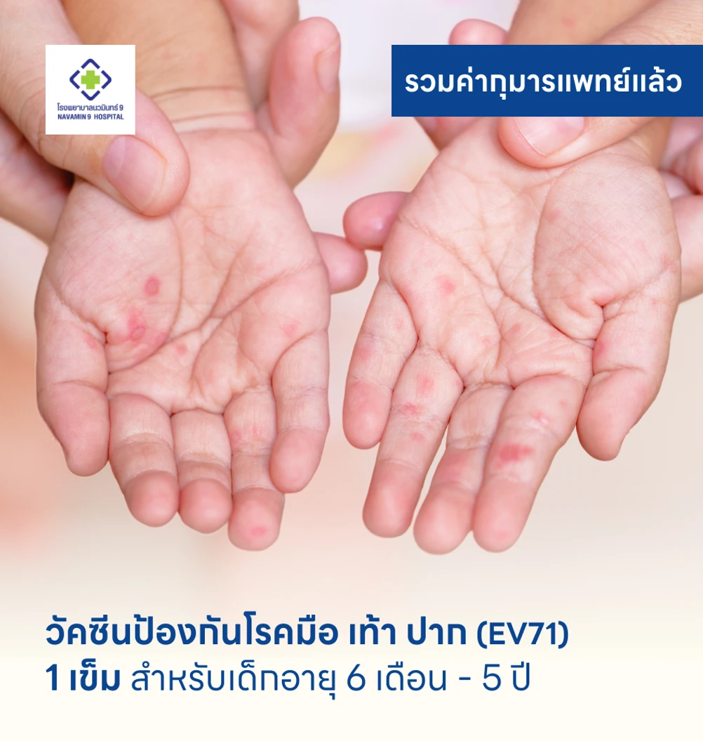 วัคซีนป้องกันโรคมือ เท้า ปาก 1 เข็ม สำหรับเด็กอายุ 6 เดือน-5 ปี