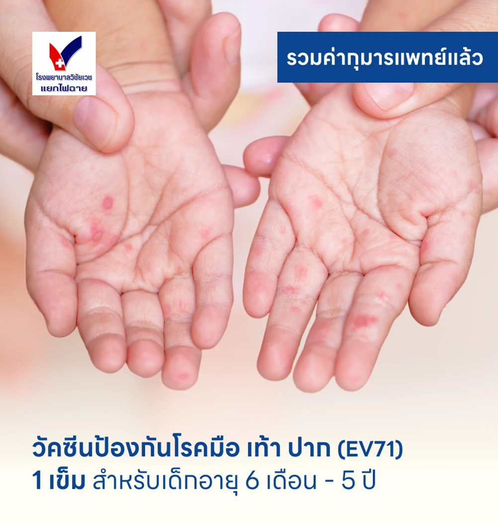 วัคซีนป้องกันโรคมือ เท้า ปาก 1 เข็ม สำหรับเด็กอายุ 6 เดือน-5 ปี