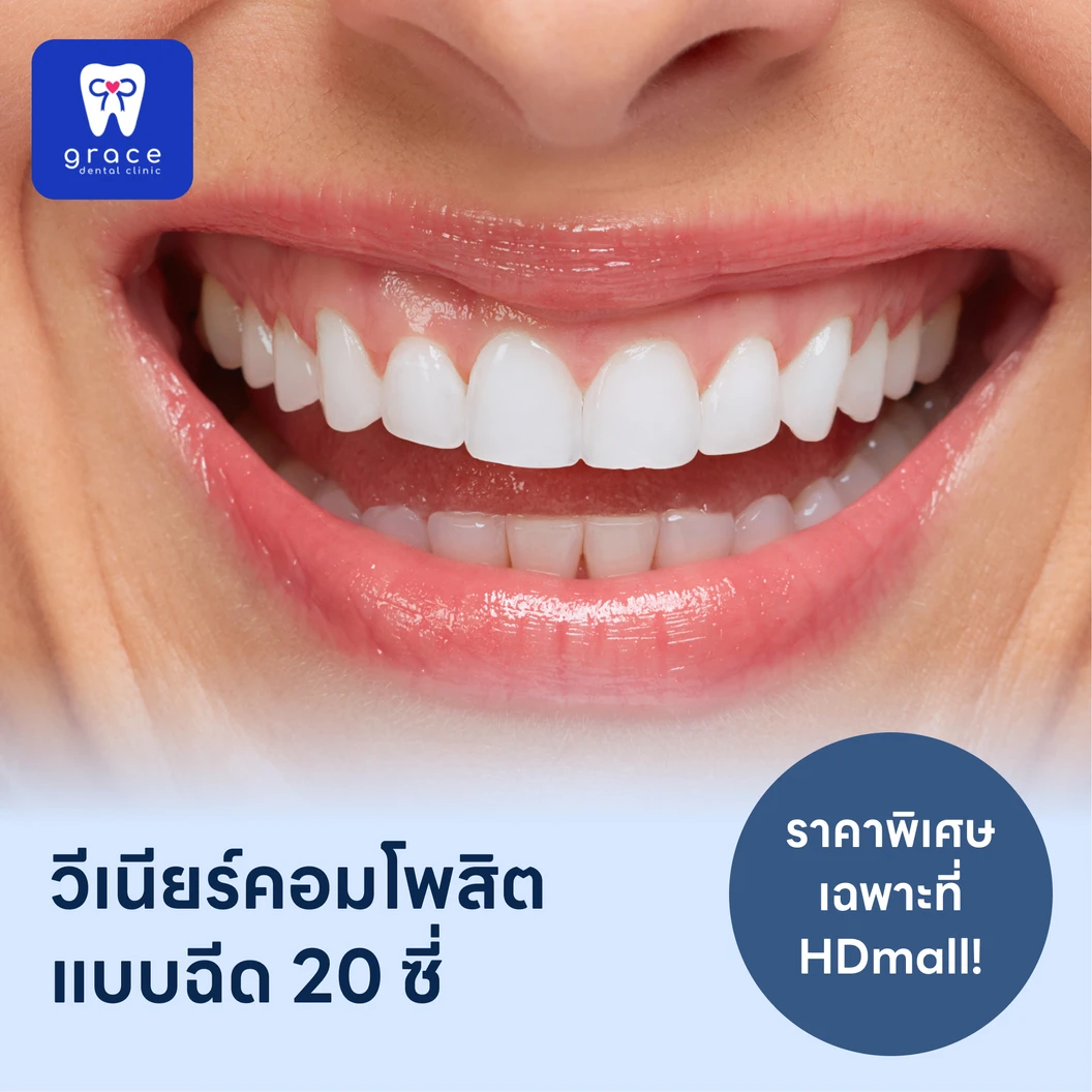 ทำวีเนียร์คอมโพสิตแบบฉีด 20 ซี่