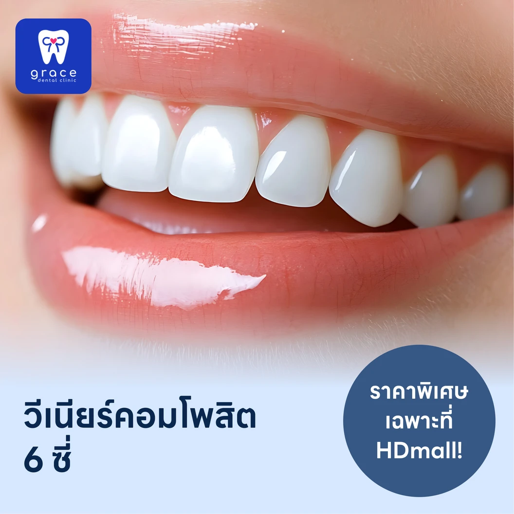 ทำวีเนียร์คอมโพสิต 6 ซี่