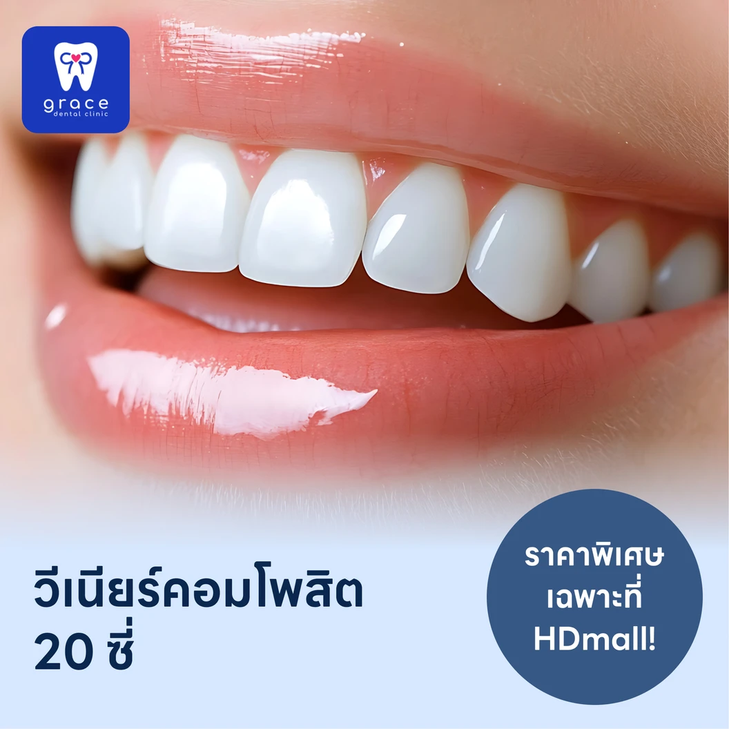 ทำวีเนียร์คอมโพสิต 20 ซี่