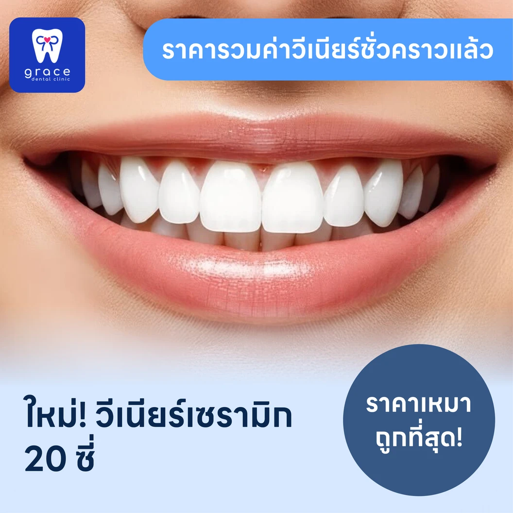 ทำวีเนียร์เซรามิก E-Max Press 20 ซี่