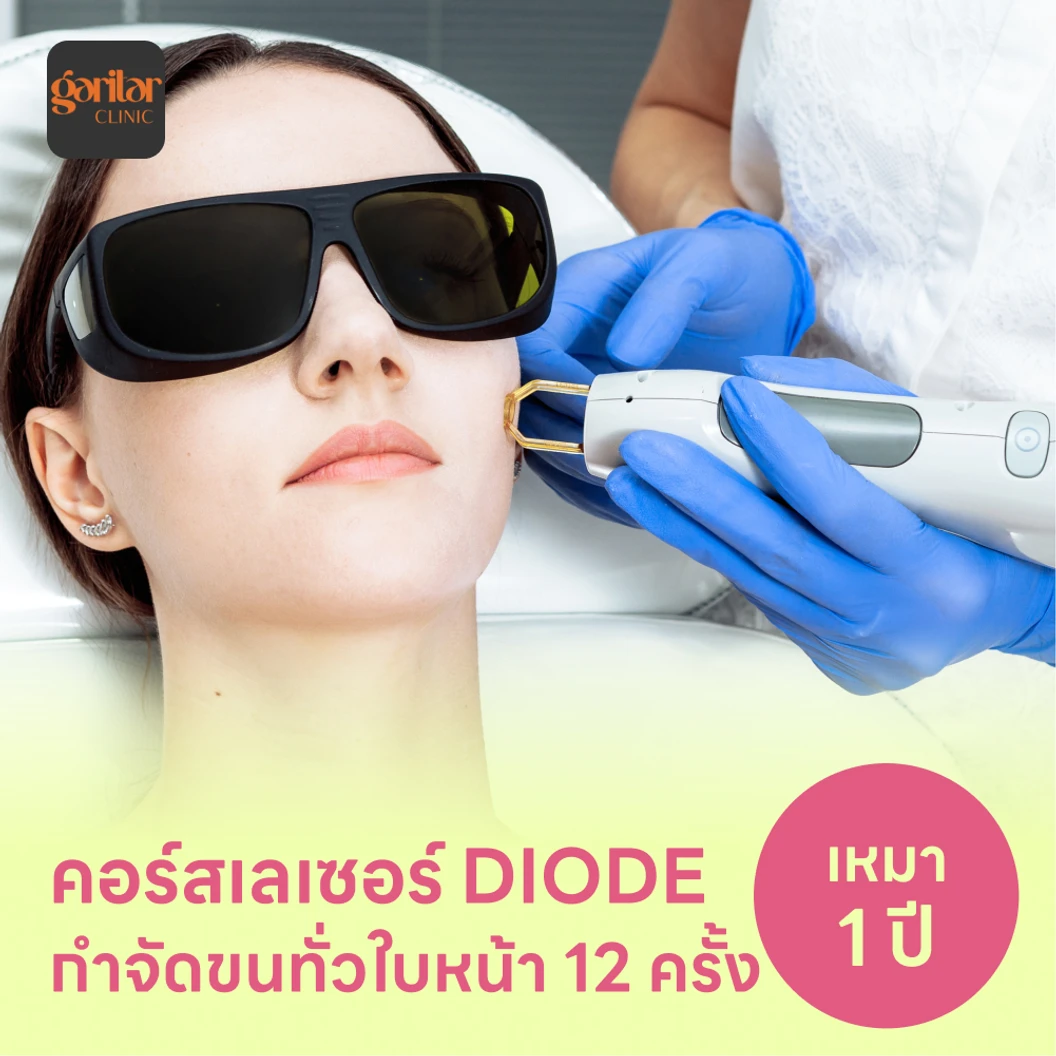 คอร์สเลเซอร์กำจัดขนทั่วหน้า 12 ครั้ง ด้วย Diode Laser